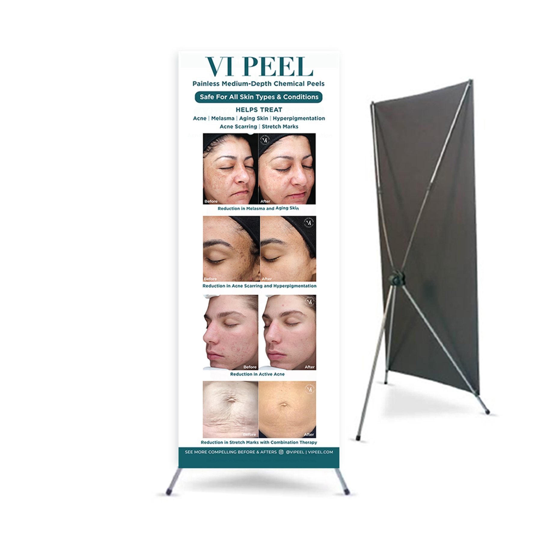 VI Peel Standing x Banner Practitioner's Office (English)