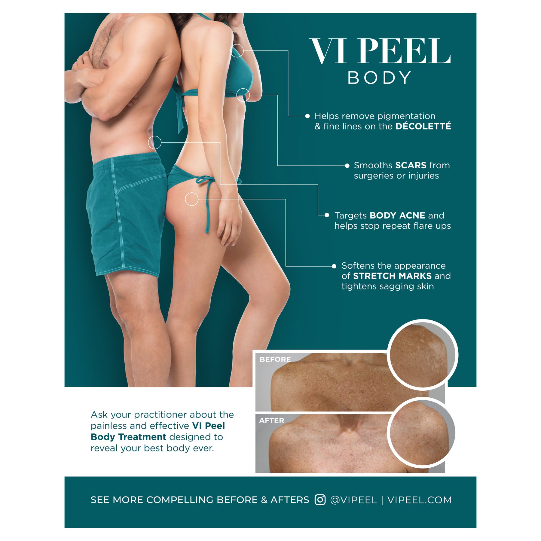 VI Peel Body Practitioners Office Poster