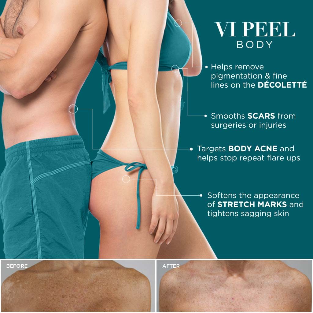 VI Peel Body Social Media Post
