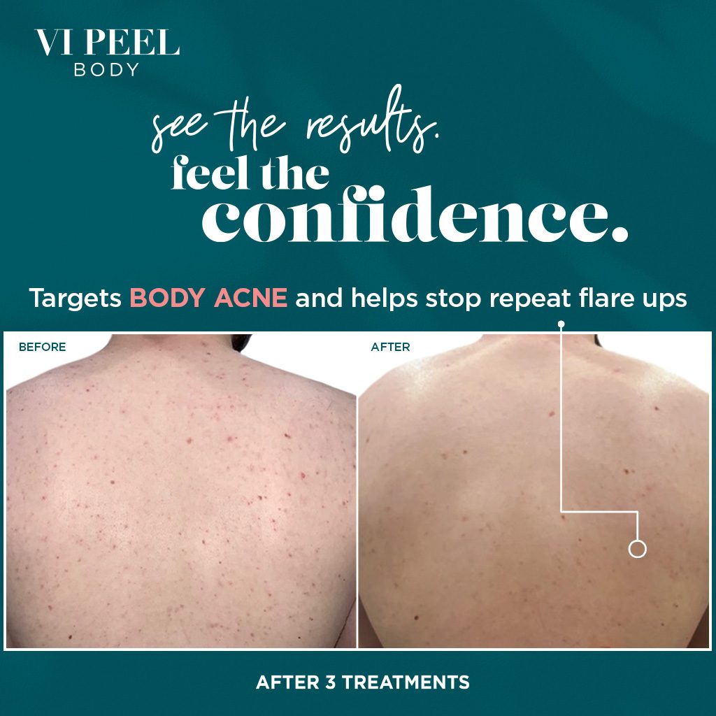 VI Peel Body Social Media Post