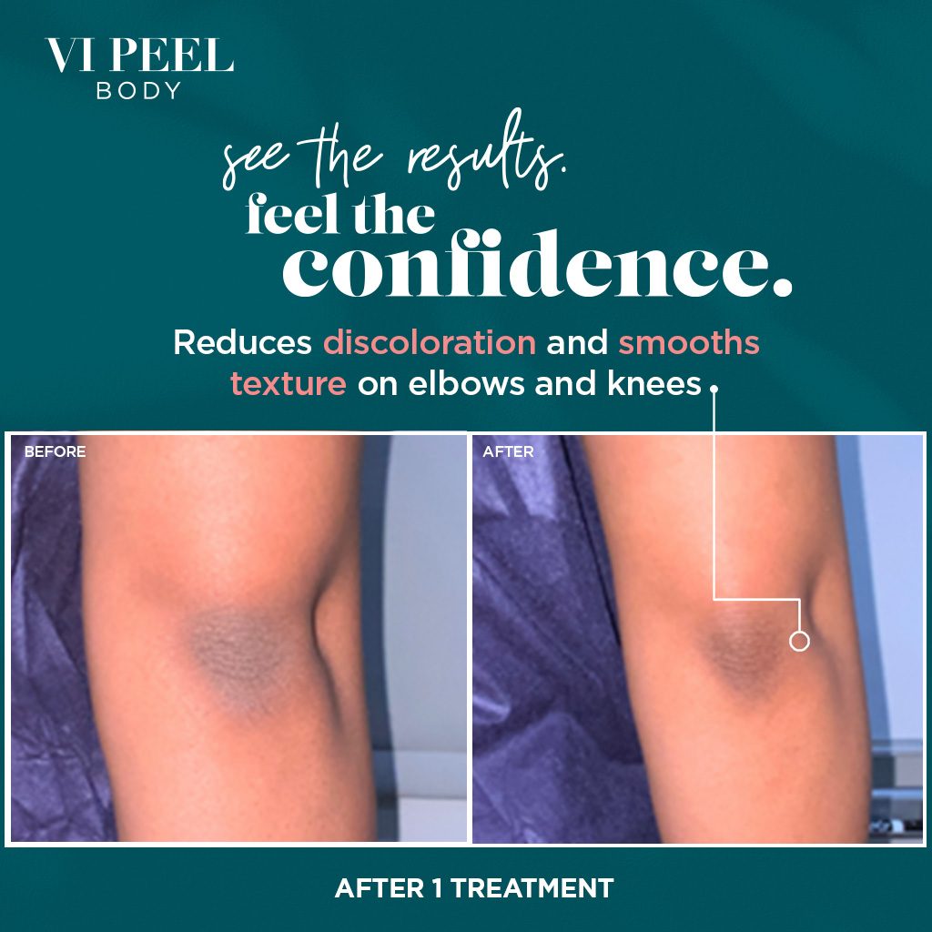 VI Peel Body Social Media Post